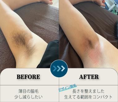 脇のビフォーアフター写真