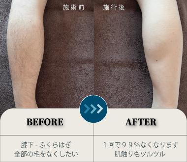 脇のビフォーアフター写真