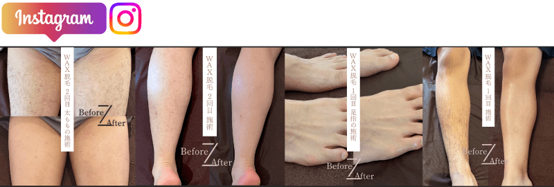 ワックス脱毛のBeforeAftar|施術事例valan成田市